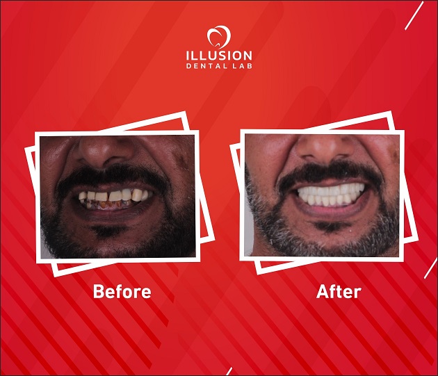 bimaxillary full mouth implant rehabilitation